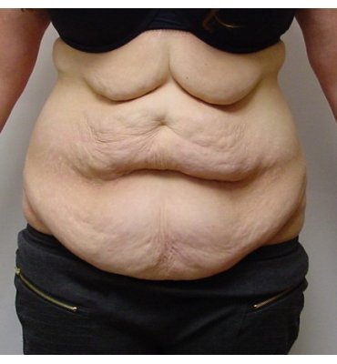 Second-stage upper abdominoplasty before